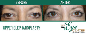 Upper Blepharoplasty Before & After