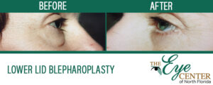 Lower Lid Blepharoplasty Before & After