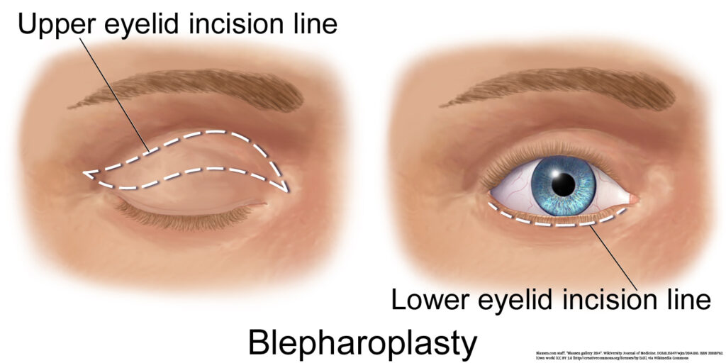 Blausen_0085_Blepharoplasty-EyeLift