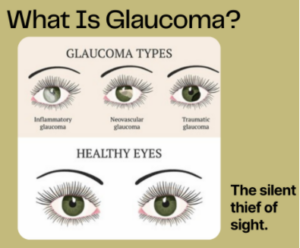 What is Glaucoma, the Silent Thief of Sight?