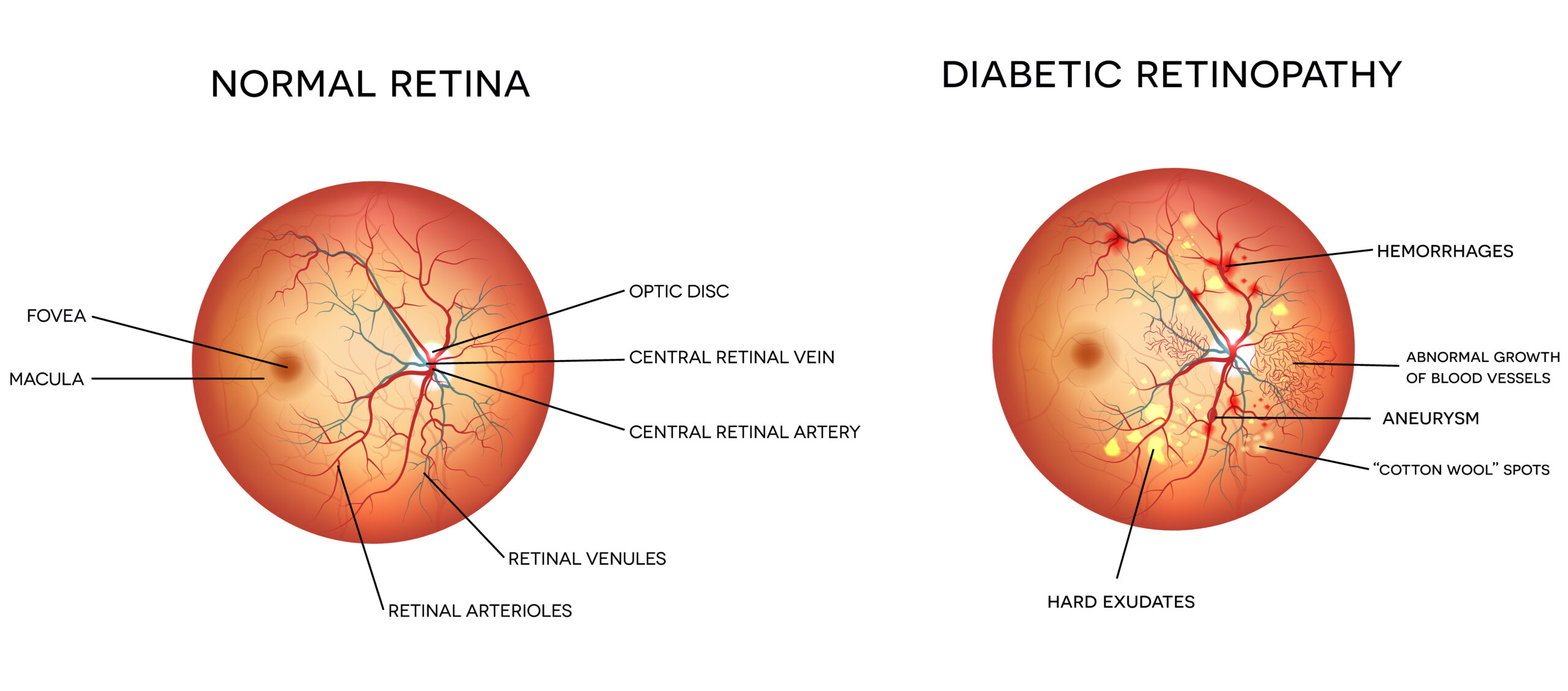 Diagram comparing normal retina with a retina with diabetic retinopathy